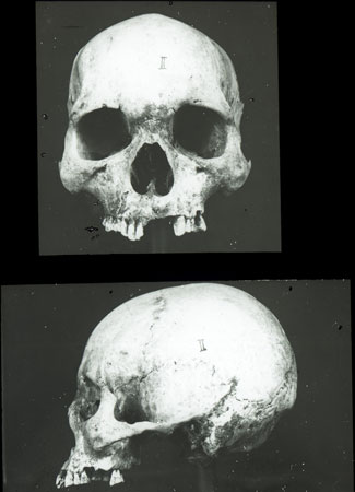 Excavated Dinka skull