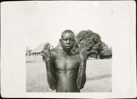 Dinka youth with leprosy